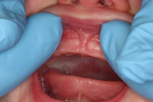 Close up of baby's mouth with doctors hands