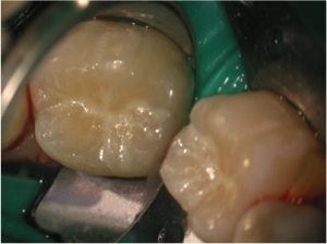Tooth Fissure Sealed Fissure sealant